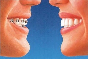 Invisalign comparison