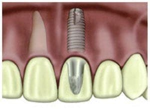dental-implant (1)