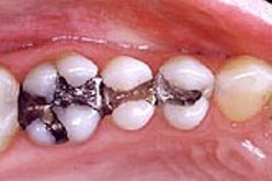 mercury-fillings