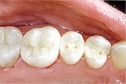mercury-free-fillings