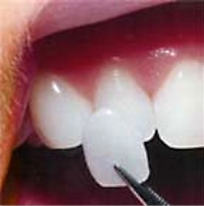 porcelain-veneer-thin