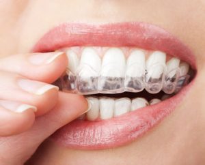 closeup photo of a woman's mouth, inserting a clear plastic tray